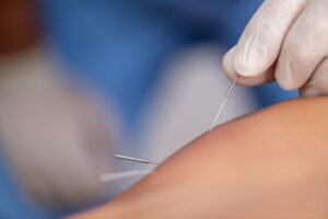 Home dry needle 1