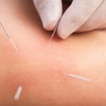 dry needle