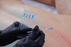 Home dry needle 3