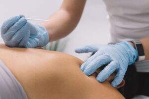 Home dry needling 6